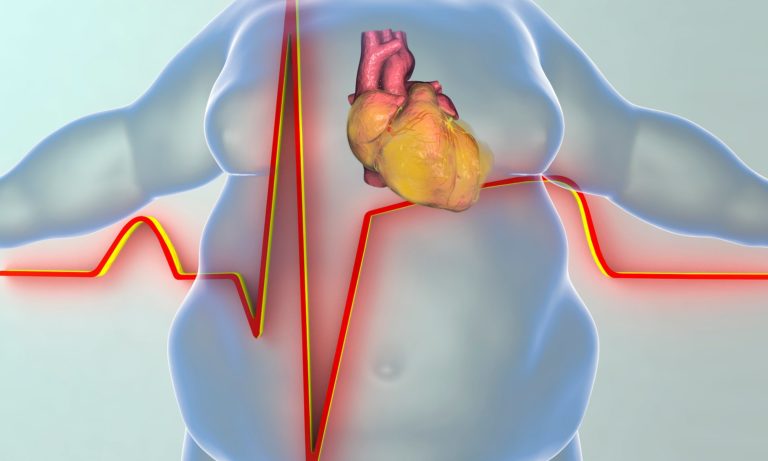 What is obesity and how it affects your health