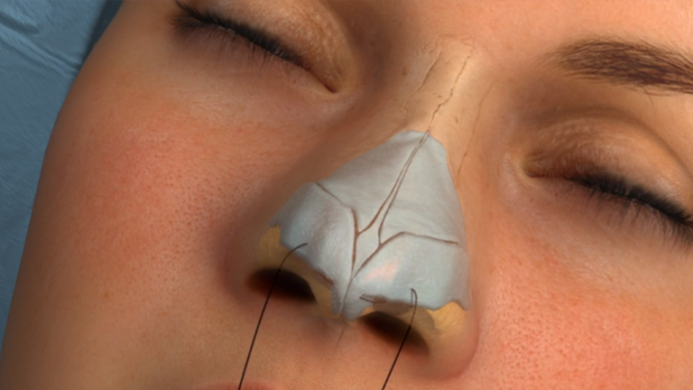 8 Things to Keep in Mind Before Plastic Surgery