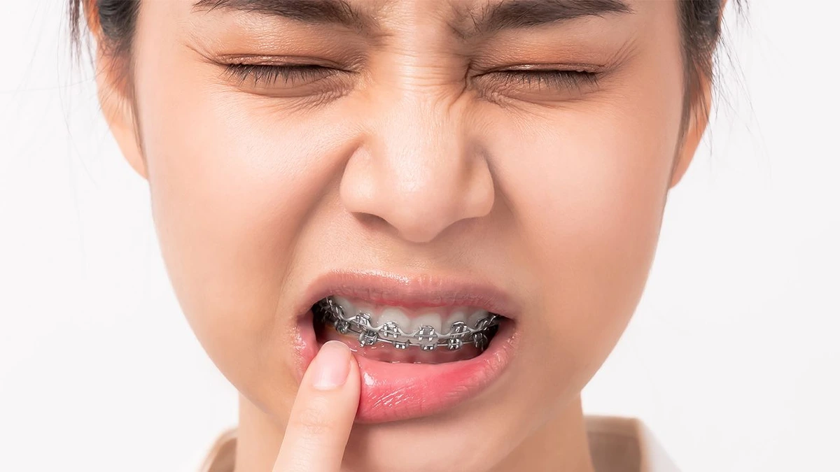 How Painful Are Braces on the First Day? 7 Things to Know