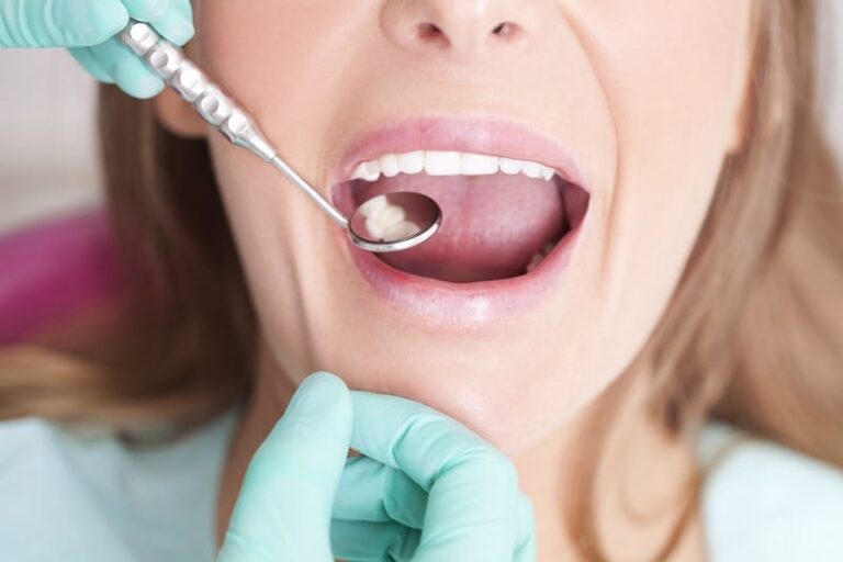 How Long Do White Fillings Last? Your Guide to Dental Restoration Durability